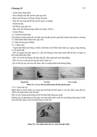 Chương 15 135
- Ambu hoặc bóng mềm.
- Pince Magill nếu đặt nội khí quản qua mũi.
- Bơm tiêm để bơm cuff hoặc mèche để chèn.
- Máy hút, hai ống hút để hút nội khí quản và miệng.
- Sonde dạ dày.
- Hệ thống cung cấp oxy.
- Máy theo dõi (Monitoring): Điện tim, SpO2, EtCO2...
- Canule Mayo.
2.2. Chuẩn bị bệnh nhân
Cần khám kỹ bệnh nhân để xác định mức độ đặt nội khí quản khó (tham khảo thêm ở chương
11; thăm khám bệnh nhân trước gây mê).
2.3. Đặt nội khí quản (NKQ)
2.3.1. Đặt tư thế
- Người đặt NKQ nên đứng và điều chỉnh bàn mổ để đầu bệnh nhân cao ngang vùng thượng
vị của người đặt.
- Đối với người lớn nằm ngữa, kê 1 gối nhỏ khoảng 10cm dưới chỏm đầu để làm cổ ngửa và
làm rộng khớp đội chẩm.
- Đối với trẻ lớn thì không cần phải đặt gối, nằm ngửa trên một mặt phẳng.
- Đối với trẻ sơ sinh cần kê một gối nhỏ ở dưới vai.
Các tư thế này tạo cho trục khí quản, hầu và miệng thành một đường thẳng.
Người lớn Trẻ lớn Trẻ sơ sinh
Hình 15.2. Các tư thế của bệnh nhân để đặt nội khí quản
2.3.2. Cung cấp oxy
Bệnh nhân có thể bị thiếu oxy trong quá trình đặt nội khí quản vì vậy cần phải cung cấp oxy
100% cho bệnh nhân trước khi đặt.
Đối với các trường hợp không tự thở thì phải bóp bóng qua mask.
Không nên cố gắng đặt nội khí quản cho một bệnh nhân xanh tím mà không bóp bóng vài lần
trước khi đặt, ngay cả khi chỉ bóp bóng với khí trời.
Hình 15.3. Cho bệnh nhân thở oxy trước khi đặt NKQ
 