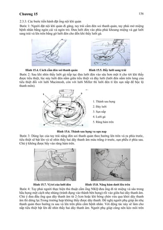 Chương 15 136
2.3.3. Các bước tiến hành đặt ống nội khí quản
Bước 1: Người đặt nội khí quản đi găng, tay trái cầm đèn soi thanh quản, tay phải mở miệng
bệnh nhân bằng ngón cái và ngón trỏ. Đưa lưỡi đèn vào phía phải khoang miệng và gạt lưỡi
sang trái và lên trên bằng gờ lưỡi đèn cho đến khi thấy lưỡi gà.
Hình 15.4. Cách cầm đèn soi thanh quản Hình 15.5. Đẩy lưỡi sang trái
Bước 2: Sau khi nhìn thấy lưỡi gà tiếp tục đưa lưỡi đèn vào sâu hơn một ít cho tới khi thấy
được tiểu thiệt, lúc này lưỡi đèn nằm giữa tiểu thiệt và đáy lưỡi (lưỡi đèn nằm trên lưng của
tiểu thiệt đối với lưỡi Macintosh, còn với lưỡi Miller thì lưỡi đèn tì lên sụn nắp để bộc lộ
thanh môn).
Hình 15.6. Thành sau họng và sụn nắp
Bước 3: Dùng lực của tay trái nâng đèn soi thanh quản theo hướng lên trên và ra phía trước,
tiểu thiệt sẽ bật lên và sẽ nhìn thấy hai dây thanh âm màu trắng ở trước, sụn phễu ở phía sau.
Chú ý không được bẩy vào răng hàm trên.
Hình 15.7. Vị trí của lưỡi đèn Hình 15.8. Nâng hàm dưới lên trên
Bước 4: Tay phải người thực hiện thủ thuật cầm ống NKQ đưa ống đi từ miệng và sâu trong
hầu họng một cách nhẹ nhàng (tránh đụng vào thành bên họng) rồi vào giữa hai dây thanh âm.
Chú ý đưa đầu ống qua dây thanh âm từ 2-3cm hoặc khi bóng chèn vừa qua khỏi dây thanh
âm thì dừng lại.Trong trường hợp không thấy được dây thanh: Đề nghị người phụ giúp ấn nhẹ
thanh quản theo hướng ra sau và lên trên phía cằm bệnh nhân. Với động tác này sẽ làm cho
nắp tiểu thiệt bật lên để nhìn thấy hai dây thanh âm. Người phụ giúp cũng nên kéo môi trên
1. Thành sau họng
2. Đáy lưỡi
3. Sụn nắp
4. Lưỡi gà
5. Răng hàm trên
 
