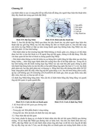 Chương 15 137
của bệnh nhân ra sau và sang phải để tạo điều kiện dễ dàng cho người thực hiện thủ thuật nhìn
thấy dây thanh âm trong quá trình đặt NKQ.
Hình 15.9. Đặt ống NKQ Hình 15.10. Hình ảnh dây thanh âm
Bước 5: Sau khi đã đặt ống NKQ qua được hai dây thanh âm, tay phải người thực hiện thủ
thuật tiếp tục giữ ống NKQ, tay trái nhẹ nhàng lấy đèn soi thanh quản ra. Sau khi đặt xong
cần kiểm tra ống NKQ có thật sự nằm trong thanh quản hay không hoặc ống NKQ vào sâu
một bên phổi. Có hai tình huống:
- Nếu bệnh nhân tự thở (trường hợp đặt NKQ không có thuốc giãn cơ), chúng ta có thể nhận
được hơi thở và âm thở thoát ra ở lỗ ngoài ống nội khí quản, chứng tỏ đã đặt đúng. Nếu đặt
vào thực quản thì hơi thở sẽ thoát ra chung quanh ống NKQ.
- Nếu bệnh nhân không tự thở thì kiểm tra sự thông khí ở phổi bằng hô hấp nhân tạo như bóp
bóng Ambu..., nhìn lồng ngực bệnh nhân lên xuống theo tần số hô hấp nhân tạo. Trong tất cả
hai tình huống trên để tránh trường hợp ống NKQ vào sâu một bên phế quản chúng ta phải
tiến hành bóp bóng kiểm tra âm thở đều cả hai phổi bằng ống nghe lần lượt ở 5 vị trí: hai đỉnh
phổi phải-trái, hai đáy phổi phải-trái và thượng vị. Đồng thời theo dõi đường biểu diễn EtCO2
hoặc chụp phim phổi để chắc chắn ống nội khí quản đúng vị trí. Sau đó bơm bóng chèn (cuff),
áp lực cuff không quá 20-22mmHg (24-25cmH2O) để tránh gây chèn ép gây thiếu máu dẫn
đến viêm, lóet sùi, xơ hóa tại chỗ về sau.
Cố định ống NKQ bằng băng dính. Nếu cần thì cố định thêm bằng dây băng bằng vải quanh
ống nội khí quản và quấn quanh đầu.
Hình 15.11. Cách rút đèn soi thanh quản Hình 15.12. Cách cố định ống NKQ
3. Kỹ thuật đặt nội khí quản qua đường mũi
3.1. Chỉ định
- Trong gây mê: Khi phẫu thuật ở vùng miệng.
- Trong hồi sức: Khi dự kiến chỉ định thở máy dài ngày.
3.2. Thực hiện đặt nội khí quản
Các bước chuẩn bị dụng cụ và chuẩn bị bệnh nhân như đặt nội khí quản (NKQ) qua đường
miệng. Về kỹ thuật đặt NKQ qua đường mũi có khác hơn. Sau khi cho bệnh nhân thở oxy
100%, đặt ống NKQ vào lổ mũi bệnh nhân (chọn ống phù hợp và đã bôi trơn ống để dể đặt)
lấy tay đẩy ống vào sâu 5-7cm, sau đó dùng đèn soi thanh quản mở miệng bệnh nhân và tìm
1. Sụn phễu
2. Khí quản
3. Sụn nắp
4. Lưỡi gà
5. Dây thanh âm
 