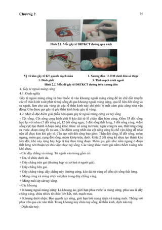 Chương 2 14
Hình 2.1. Mốc gây tê ĐRTKCT đường qua nách
Vị trí kim gây tê KT quanh mạch máu 1. Xương đòn 2. ĐM dưới đòn sờ được
1. Đỉnh phổi 3. Tĩnh mạch cảnh ngoài
Hình 2.2. Mốc để gây tê ĐRTKCT đường trên xương đòn
4. Gây tê ngoài màng cứng
4.1. Định nghĩa
Gây tê ngoài màng cứng là đưa thuốc tê vào khoang ngoài màng cứng để ức chế dẫn truyền
các rễ thần kinh xuất phát từ tuỷ sống đi qua khoang ngoài màng cứng, qua lỗ liên đốt sống và
ra ngoài, làm cho các vùng do các rễ thần kinh này chi phối bị mất cảm giác cũng như vận
động. Còn được gọi gây tê gốc thần kinh hoặc gây tê vùng.
4.2. Một số đặc điểm giải phẫu liên quan gây tê ngoài màng cứng và tuỷ sống
- Cột sống: Cột sống cong hình chữ S kéo dài từ lỗ chẩm đến hỏm cùng. Gồm 33 đốt sống
hợp lại với nhau (7 đốt sống cổ, 12 đốt sống ngực, 5 đốt sống thắt lưng, 5 đốt sống cùng, 4 đốt
sống cụt) tạo thành 4 đoạn cong khác nhau: cổ cong ra trước, ngực cong ra sau, thắt lưng cong
ra trước, đoạn cùng lồi ra sau. Các điểm cong nhất của cột sống cũng là chỗ vận động dễ nhất
nên dễ chọc kim khi gây tê. Cấu tạo mỗi đốt sống bao gồm: Thân đốt sống, lỗ đốt sống, mỏm
ngang, mỏm gai, cung đốt sống, mỏm khớp trên, dưới. Giữa 2 đốt sống kề nhau tạo thành khe
liên đốt, khe này rộng hay hẹp là tuỳ theo từng đoạn. Mỏm gai gần như nằm ngang ở đoạn
thắt lưng nên thuận lợi cho việc chọc tuỷ sống. Các vùng khác mỏm gai nằm chếch xuống nên
khó chọc.
- Các dây chằng và màng. Từ ngoài vào trong gồm có:
+ Da, tổ chức dưới da.
+ Dây chằng trên gai (thường hẹp và xơ hoá ở người già).
+ Dây chằng liên gai.
+ Dây chằng vàng, dây chằng này thường cứng, kéo dài từ vùng cổ đến cột sống thắt lưng.
+ Màng cứng và màng nhện sát phía trong dây chằng vàng.
+ Màng nuôi áp sát tuỷ sống.
- Các khoang
+ Khoang ngoài màng cứng: Là khoang ảo, giới hạn phía trước lá màng cứng, phía sau là dây
chằng vàng, chứa nhiều tổ chức liên kết, mỡ, mạch máu.
+ Khoang dưới nhện: Bao quanh tuỷ sống, giới hạn bởi màng nhện và màng nuôi. Thông với
phía trên qua các não thất. Trong khoang này chứa tuỷ sống, rễ thần kinh, dịch não tuỷ.
- Dịch não tuỷ:
 