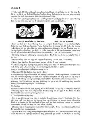 Chương 2 17
+ Tư thế ngồi: Để bệnh nhân ngồi cong lưng, hai chân để trên ghế đẩu, hay tay thả lỏng. Tư
thế này có thể dễ xác định các khe đốt sống hơn nhưng thường gây tụt huyết áp hoặc cảm giác
khó chịu cho bệnh nhân, thường dành cho những người mập.
+ Tư thế nằm nghiêng cong lưng tôm: Hai đầu gối áp sát vào bụng cằm tì vào ngực. Thường
dành cho các bệnh nhân già yếu để tránh tụt huyết áp, ngất, xỉu, khó chịu...
Hình 2.5. Tư thế nằm gây tê tuỷ sống. Hình 2.6. Cách bơm thuốc
- Cách xác định vị trí chọc: Thường chọc vào khe giữa 2 đốt sống do vậy vị trí chọc sẽ phụ
thuộc vào phẫu thuật cao hay thấp. Thông thường chọc từ khoảng liên đốt L2-L3 đến khoảng
L4-L5 đường nối hai mào chậu của xương chậu thường đi qua L4-L5, sau đó dùng ngón tay
chuyển dịch lên trên sẽ thấy khe L2-L3 và L3-L4. Ngược lại có thể xác định từ trên xuống bằng
lấy mốc gốc sườn lưng kẻ xuống sẽ tương đương với L1-L2 rồi xác định trở xuống.
- Sát trùng: Dùng cồn sát trùng tại vùng chọc kim 3 đến 4 lần, sau đó lau khô và phủ khăn lỗ
lên trên.
- Chọc tuỷ sống: Đảm bảo tuyệt đối nguyên tắc vô trùng khi tiến hành kỹ thuật này
+ Người chọc tủy sống: đeo khẩu trang, rửa tay, mặc áo, đi găng vô khuẩn.
+ Có hai đường chọc: đường chọc giữa và đường chọc bên, với đường chọc bên vị trí chọc
cách đường giữa 1,5-2cm, hướng kim vào đường giữa, lên trên, ra trước.
+ Gây tê tại chỗ vùng chọc bằng lidocaine 0,5-1%.
+ Dùng kim 18G dẫn đường, chọc sâu từ 1-2cm.
+ Dùng kim tuỷ sống luồn qua kim dẫn đường 3-5cm (vát kim hướng lên trên khi bệnh nhân
nằm, vát kim nằm nghiêng khi bệnh nhân ngồi) rút nòng kim nếu thấy dịch não tuỷ chảy ra
tức là kim đã ở trong khoang tuỷ sống (kim càng bé thì dịch não tuỷ chảy ra càng chậm).
Khi dùng kim 22-24G chọc tuỷ sống thì không cần gây tê tại chỗ và không dùng kim dẫn
đường (hiện nay không dùng cỡ kim loại này).
5.5. Tai biến
Suy thở do liệt các cơ liên sườn. Ngừng thở do thuốc tê lên cao gây liệt cả cơ hoành. Hạ huyết
áp hay trụy mạch. Nôn, buồn. Mạch chậm. Rối loạn nhịp tim. Co giật. Bí đái. Nhức đầu. Liệt
thần kinh hồi phục chậm hay không phục hồi.
6. Gây tê qua khe xương cùng
- Gây tê qua khe xương cùng cũng là loại gây tê ngoài màng cứng, kỹ thuật này được thực
hiện bằng cách chọc kim qua khe xương cùng vào nón cùng của khoang ngoài màng cứng
Thuốc tê sẽ làm ức chế dẫn truyền các rễ thần kinh tủy sống nằm trong khoang này và từ đó
làm mất cảm giác và vận động các vùng mà nó chi phối.
- Chỉ định: Gây tê ống cùng đơn thuần (20ml lidocaine 2%) để mổ vùng hậu môn, phẫu thuật
đáy chậu, bộ phận sinh dục ngoài.
- Tai biến: Kim chọc thủng màng cứng làm tê tủy sống toàn bộ. Kim chọc vào mạch máu gây
nhiễm độc thuốc tê. Hạ huyết áp (do tác dụng giãn mạch quá nhanh). Mạch chậm (do tác dụng
 