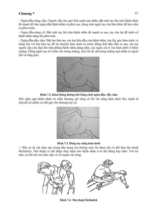 Chương 7 61
- Ngửa đầu-nâng cằm: Người cấp cứu quỳ bên cạnh nạn nhân, đặt một tay lên trán bệnh nhân
đè mạnh để làm ngửa đầu bệnh nhân ra phía sau, dùng một ngón tay của bàn khác để kéo cằm
ra phía trước.
- Ngửa đầu-nâng cổ: Đặt một tay lên trán bệnh nhân đè mạnh ra sau, tay còn lại để dưới cổ
bệnh nhân nâng lên phía trên.
- Ngửa đầu-đẩy cằm: Đặt hai bàn tay vào hai bên đầu của bệnh nhân, ôm lấy góc hàm dưới và
nâng lên với hai bàn tay để di chuyển hàm dưới ra trước đồng thời đẩy đầu ra sau, cùi tay
người cấp cứu dựa lên mặt phẳng bệnh nhân đang nằm, các ngón cái tì vào hàm dưới ở khóe
miệng. Dùng ngón tay trỏ luồn vào trong miệng, móc bỏ dị vật trong miệng nạn nhân ra ngoài
(kể cả răng giả).
Hình 7.2. Khai thông đường thở bằng cách ngửa đầu- đẩy cằm
Khi nghi ngờ bệnh nhân có chấn thương cột sống cổ thì chỉ nâng hàm dưới lên, tránh di
chuyển cổ nhiều có thể gây tổn thương tuỷ cổ.
Hình 7.3. Dùng tay nâng hàm dưới
+ Nếu có dị vật nằm sâu trong hầu họng mà không móc bỏ được thì có thể làm thủ thuật
Heilmlich. Thủ thuật có thể được thực hiện cho bệnh nhân ở tư thế đứng hay nằm. Với trẻ
nhỏ, có thể cho trẻ nằm sấp và vỗ mạnh vào lưng.
Hình 7.4. Thủ thuật Heilmlich
 