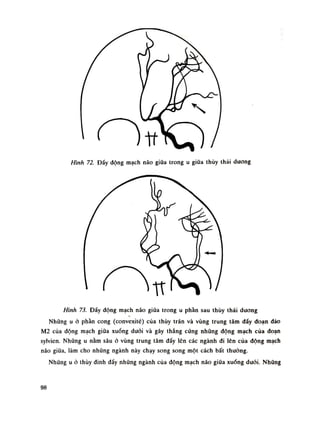 Hình 72. Đầy dộng mạch não giũa trong u giũa thúy thái dương
Hình 73. Đẩy dộng mạch não giữa trong u phần sau thủy thái dương
Nhũng u à phần cong (convexité) cùa thúy trán và vùng trung tâm dấy đoạn dào
M2 của động mạch giũa xuống dưới và gây thẳng cứng nhũng dộng mạch của đoạn
sylvien. Nhũng u nằm sâu ỏ vùng trung tâm đầy lên các ngành đi lên của dộng mạch
não giũa, làm cho nhũng ngành này chạy song song một cách bất thuồng.
Nhũng u ó thúy dinh đẩy nhũng ngành của động mạch não giữa xuống đuôi. Nhũng
98
 