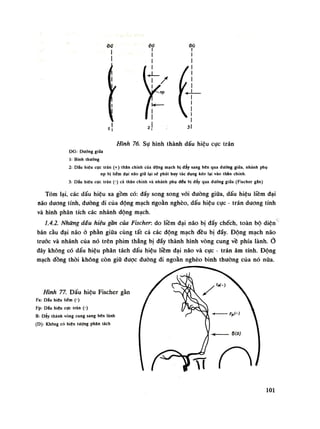 •Dơ -Dữ $ữ
Hình 76. Sự hình thành dấu hiệu cục trán
DG: Dưàng giũa
1: Binh thướng
2: Dấu hiệu cực trán (+) thân chỉnh cùa động mạch bị dẩy sang bên qua đường giũa, nhánh phụ
np bị liêm đại não giữ lại sẽ phát huy tác dụng kéo lại vào thân chính.
3: Dâu hiệu cực trán (-) cả thân chính và nhánh phụ đểu bị đầy qua đường giữa (Fischer gắn)
Tóm lại, các dấu hiệu xa gồm có: đẩy song song vói đường giữa, dấu hiệu liềm đại
não dương tính, dường đi của động mạch ngoằn nghèo, dấu hiệu cục - trán dương tính
và hình phân tích các nhánh động mạch.
1.4.2. Những dấu hiệu gần của Fischer: do liềm đại não bị đấy chếch, toàn bộ diện
bán cầu đại não ò phần giũa cùng tất cả các động mạch đều bị đẩy. Động mạch não
trước và nhánh của nó trên phim thẳng bị đẩy thành hình vòng cung về phía lành.Ỏ
đây không cố dấu hiệu phân tách dấu hiệu liềm đại não và cục - trán âm tính. Động
mạch đồng thòi không còn giữ dược dường đi ngoằn nghèo bình thường của nó nữa.
Hình 77. Dấu hiệu Fischer gàn
Fa: Dấu hiệu liềm (-)
Fp: Dấu hiệu cực trán (-)
B: Dày thành vống cung sang bẽn lành
(D): Không có hiện tượng phan lách
loi
 