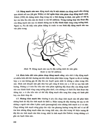 1.5. Động mạch não sau: động mạch này là một nhánh cùa động mạch nền nhung
qua nhánh nối sau (đá giác Willis) có thế ngấm dược trên phim chụp động mạch cành.
Ziilch (1950) đã chứng minh rằng trong các u thái duong và dinh, não giữa có thể bị
kẹt vào khe Têu tiều não do thoát vị vào bể ambieus. Trong truồng họp này đoạn dầu
của động mạch não sau và nhánh thông sau bị đẩy thành hình vòng cung xuống đuối.
Ngoài ra, Pia đã thấy trên phim thẳng tù trước ra sau hình dấy động mạch náo sau
vào phía trong.
Hình 78. Động mạch não sau bị dẩy xuống đuôi do não giũa
thoát vị vào bề ambieus
1.6. Hỉnh biên dổi trên phim chụp dộng mạch sống: nên nhó à đây dộng mạch
có nhiêu biến đối bất thuồng mà khi chẩn đoán phải thận trọng. Ngoài ra đã có truồng
họp u to mà không gây đè đẩy lên các huyết quàn nhất là những u nằm trong tiêu
não. Hình ảnh khuyết não gàn nhu bao giò cũng đi kèm các uở hố sọ sau làm ảnh
hường. Nhũng u ỏ trên lều tiếu não trên phim nghiêng dấy đoạn dầu của dộng mạch
não sau thành hình vòng cung xuống phía dưới, còn nhũng u à đuôi Têu làm đoạn này
thẳng dẹt, u ò cầu tiều não có thế đấy động mạch nền sang bên cùng vói hình phá
hủy của đinh tháp đá.
1.7. Những tĩnh mạch ỉđn: thường ít yêu càu chụp tĩnh mạch não dế phát hiện
nhũng hình đè đầy lèn tĩnh mạch do khói u. Hiện tượng dè dẩy thường chi xảy ra vói
nhũng u ngoài não năm ỏ phía cạnh (parasagittal) trên nhũng tĩnh mạch to ò vò não.
Chụp những tĩnh mạch nông giúp cho việc tìm phương hướng trong khi mổ vì nó dễ
tìm hon những động mạch nằm sâu trong chất não, càn chú trọng tói hiện tuông dè
đầy lên các tĩnh mạch não bên trong, nhất là tĩnh mạch lớn Galeni, trong những u ỏ
gằn các hạch thân não.
102
 
