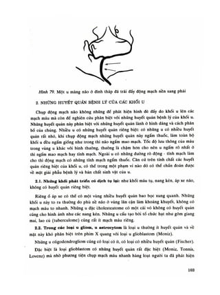 Hình 79. Một u màng não ỏ đinh tháp đá trái dầy động mạch nên sang phải
2. NHỮNG HUYẾT QUẦN BỆNH LÝ CỦA CÁC KHỐI u
Chụp động mạch náo không những đế phát hiện hình đè đầy do khói u lên các
mạch máu mà còn đế nghiên cứu phân biệt vói nhũng huyết quản bệnh lý của khói u.
Những huyết quản này phân biệt vói những huyết quản lành ỏ hình dáng và cách phân
bố của chúng. Nhiều u có nhũng huyết quản riêng biệt: có những u có nhiều huyết
quán rất nhỏ, khi chụp động mạch những huyết quản này ngấm thuốc, làm toàn bộ
khói u đều ngấm giống nhu trong thì não ngấm mao mạch. Tóc độ luu thông của máu
trong vùng u khác vói bình thường, thuồng là chậm hon cho nên u ngấm rõ nhất ỏ
thì ngấm mao mạch hay tĩnh mạch. Ngoài u có những đường rò động - tĩnh mạch làm
cho thì động mạch có nhũng tĩnh mạch ngấm thuốc. Căn cứ trên tính chất các huyết
quản riêng biệt cùa khối u, có thể trong một phạm vi nào đó có thế chấn đoán được
về mặt giải phẫu bệnh lý và bản chất sinh vật của u.
2.1. Những khối phát triển có dịch tụ lại: nhu khối máu tụ, nang kén, áp xe náo,
không có huyết quản riêng biệt.
Riêngổ áp xe có thế có một vùng nhiều huyết quản bao bọc xung quanh. Nhũng
khói u này to ra thường do phù nề não ỏ vùng lân cận làm khoảng khuyết, không có
mạch máu to nhanh. Nhũng u dặc bholesteatome có một cái vỏ không có huyết quán
cũng cho hình ảnh nhu các nang kén. Nhũng u cấu tạo bời tổ chức hạt nhu gôm giang
mai, lao củ (tuberculome) cũng rất ít mạch máu riêng.
2.2. Trong các loại u gliom, u astrocytom là loại u thường ít huyết quản và về
mặt này khó phân biệt trên phim X quang vói loại u glioblastom (Moniz).
Nhũng u oligodendrogliom cũng có loại có ít, có loại có nhiều huyết quản (Fischer).
Đặc biệt là loại glioblastom có nhũng huyết quàn rất đặc biệt (Moniz, Tonnis,
Lovenz) mà nhò phương tiện chụp mạch máu nhanh hàng loạt nguôi ta dã phát hiện
103
 