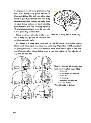 Ò vùng đáy sọ còn có nhũng gliobiastom vùng
nền - trán. Nhũng u này gây đe đẩy lên các
dộng mạch không điển hình bằng các u màng
não thính giác. Ngoài ra ta phải ké tói u màng
não của xương bướm. Những u này ngấm thuốc
rất mạnh, thường nhò qua các ngành của động
mạch màng não giữa. Ông cùa động mạch này
(lỗ tròn bé) thường bị giãn to, có thề phát hiện
rõ trên phim chụp sọ theo Hirtz.
Nhũng u ỏ truóc và trên tuyến yên (u sọ
hầu, u màng não) gây đẩy lên cao đoạn dầu
của động mạch não trước.
3.3. Những u ở vùng hạch than não: chi phát hiện được rỗ trên phim chụp ỏ
thì tĩnh mạch (Fischer) và phim chụp động mạch sóng. u pinéslom có thể ngấm thuốc
cản quang (Radiner). u Lindan ò hố sọ sau có nhiều mạch máu và ngấm rõ trên phim
chụp động mạch sống. Nhưng thuồng nguôi ta phát hiện những u ỏ thân náo chù yếu
bằng bơm hoi não thất.
Hình 82. Ư màng não tù mảnh sàng
Hình 83. Hình đè dẩy lên các động
mạch não trên phim chụp thẳng
1: Binh thường
2: u truỏc hố yên, trên đưòng giữa
3: u vùng trán
4: u thái dương
5: Khới máu tụ dưới màng cứng
6: u ỏ phía đổi diên
(Theo Kautzky và Ziilch)
108
 