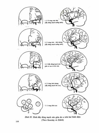 1. u ỏ vùng trán bén
(dày động mạch xuống dưới)
2. u vùng trán - thái dường
(đây động mạch xuống dưới)
3. li dây dộng-mạch não
giữa ra sau và lân trẽn
4.Ụ vùng thái dường
(đẩy động mạch lên cao)
5. u vùng đình sau
Hình 85. Hình đẩy động mạch náo giữa do u trên hai bình diện
(Theo Kautzky và Ziiỉch)
 