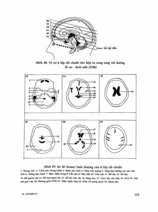 Hình 88. Vị trí 6 lốp cắt chuẩn cho hộp sọ song song vói đường
lỗ tai - đuối mắt (OM)
Hình 89. So dồ Scaner bình thuồng cùa 6 lóp cắt chuẩn
Ì- Xoang trán 2- Cánh nhỏ xuống bươm 3- Mỏm yên nưổc 4- Thúy thái dường 5- sừng thái dường cùa não Ihát
Irên 6- Thang bào chũm 7- Mào chàm trong 8- câu não 9- Não Ihắl lo- Tiểu não li- Bẻ đáy 12- Bẻ đào
13- Bẽ quanh câu 14- Bẻ lính mách lòn 15- Bê liên bán câu 16- sùng trán 17- Vách liên não thát 18- NT3 19- Thê
tam giác nao 20- Khoang giữa NTB 21- Thân tuyến tùng 22- Dám rối màng mạch 23- Rãnh nao.
Te - CPPCĐBTVTK 113
 