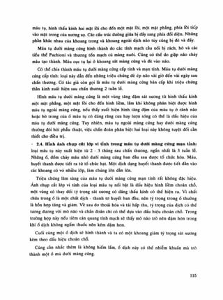 máu tụ, hình thấu kính hai mặt lồi cho đến một mặt lồi, một mặt phăng, phía lồi tiếp
vào mặt trong cùa xương sọ. Các cấu trúc đưòng giũa bị đấy sang phía dối diện. Nhũng
phàn khác nhau của khoang trong và khoang ngoài dịch náo tủy cũng bị dè và đẩy.
Máu tụ đuôi màng cứng hình thành do các tĩnh mạch cầu nói bị rách, hò và các
tiểu thè Pachioni và thương tổn mạch củ màng nuôi. Cũng có thể do giập náo chảy
máu tạo thành. Máu cục tụ lại ỏ khoang sát màng cúng và đè vào não.
Có thè chia thành máu tụ đuối màng cứng cấp tính và mạn tính. Máu tụ đuôi màng
cứng cấp tính: loại này dẫn đến những triệu chứng đè ép náo vài giò đến vài ngày sau
chấn thương. Có tác giả còn gọi là máu tụ đuôi màng cúng bán cấp khi triệu chúng
thần kinh xuất hiện sau chấn thương 2 tuần lễ.
Hình máu tụ đuôi màng cúng là một vùng tăng đậm sát xương tù hình thấu kính
một mặt phẳng, một mặt lồi cho đến hình liềm, lắm khi không phân biệt duọc hình
máu tụ ngoài màng cúng, nếu thấy xuất hiện hình tăng đậm của máu tụ ỏ rãnh não
hoặc bò trong của ổ máu tụ có dáng răng cưa hay lượn sóng có thể là dấu hiệu của
máu tụ dưới màng cúng. Tuy nhiên, máu tụ ngoài màng cúng hay đuôi màng cúng
thường đòi hỏi phẫu thuật, việc chẩn đoán phân biệt hai loại này không tuyệt đối càn
thiết cho điều trị.
• 2.4. Hĩnh ảnh chụp cát lớp vi tính trong máu tụ dưới màng cứng mạn tỉnh:
loại máu tụ này xuất hiện tù 2 - 3 tháng sau chấn thương, ngắn nhất là 3 tuần lẻ.
Những ổ, đốm chảy máu nhỏ đuôi màng cúng ban đầu sau được tổ chúc hóa. Máu,
huyết thanh đuọc tiết ra tù tổ chúc hạt. Một dịch dạng huyết thanh được tiết dàn vào
các khoang có vỏ nhiều lớp, làm chúng lớn dần lên.
Triệu chúng lâm sàng của máu tụ dưới màng cứng mạn tính rất không đặc hiệu.
Ánh chụp cắt lóp vi tính của loại máu tụ nối bật là dấu hiệu hình liêm choán chỗ,
một vùng có thay đổi tỷ trọng sát xương có dáng thấu kính có thề hiện ra. Vì chất
chứa trongổ là một chất dịch - thanh to huyết ban đầu, nên tỳ trọng trongố thường
là hỗn họp tăng và giảm. Ve sau do thoái hóa và tái hấp thu, tỳ trọng của dịch có thế
tuông đương vói mô não và chần đoán chi có thể dựa vào dấu hiệu choán chỗ. Trong
trường họp này nếu tiêm cản quang tĩnh mạch sẽ thấy mô não trò nên đậm hon trong
khiổ dịch không ngấm thuốc nên kém đậm hon.
Cuối cùng mộtố dịch sẽ hình thành và ta có một khoang giảm tỷ trọng sát xuong
kèm theo dấu hiệu choán chỗ.
Cũng cần nhắc thêm là không hiếm lắm,ổ dịch này có thề nhiễm khuẩn mà trỏ
thành mộtồ mù dưới màng cúng.
115
 