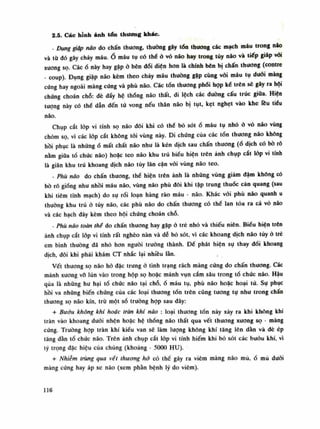 2.5. Các hỉnh ảnh tổn thương khác.
- Dụng giập não do chấn thương, thường gây tổn thương các mạch máu trong não
và tù dó gây chảy máu.Ố máu tụ có thể ỏ vỏ não hay trong tủy náo và tiếp giáp vói
xương sọ. Cácổ này hay gặp ỏ bên đối diện hon là chính bên bị chấn thương (contre
- coup). Đụng giập náo kèm theo chảy máu thuòng gập cùng vối máu tụ duỗi màng
cứng hay ngoai màng cứng và phù não. Các tổn thương phôi họp ké trên sẽ gảy ra hội
chứng choán chỗ: dè đẩy hệ thống não thất, di lệch các dường cấu trúc giữa. Hiện
tượng này có thè dẫn đến tử vong nếu thân não bị tụt, kẹt nghẹt vào khe Têu tiêu
não.
Chụp cắt lốp vi tính sọ não đôi khi có thể bỏ sót ổ máu tụ nhỏ ỏ vỏ náo vùng
chỏm sọ vì các lốp cắt không tói vùng này. Di chúng của các tổn thương não không
hồi phục là nhũngố mất chất não nhu là kén dịch sau chấn thuong (ổ dịch có bò rõ
nằm giũa tổ chức não) hoặc teo não khu trú biểu hiện trên ảnh chụp cắt lóp vi tính
là giãn khu trú khoang dịch não tủy lân cận vói vùng não teo.
- Phù não do chấn thương, thể hiện trên ảnh là nhũng vùng giảm dậm không có
bò rỗ gióng nhu nhồi máu não, vùng não phù dôi khi tập trung thuốc cản quang (sau
khi tiêm tĩnh mạch) do sự rói loạn hàng rào máu - náo. Khác vói phù não quanh u
thường khu trú ỏ tủy não, các phù não do chấn thương có thể lan tỏa ra cả vỏ não
và các hạch đáy kèm theo hội chúng choán chỗ.
- Phù não toàn thề do chấn thuong hay gặp ỏ trẻ nhỏ và thiếu niên. Biếu hiện trên
ảnh chụp cắt lốp vi tính rất nghèo nàn và dẻ bỏ sót, vì các khoang dịch não tủy ỏ trê
em bình thường đã nhỏ hon nguôi truồng thành. Đè phát hiện sụ thay đối khoang
dịch, dôi khi phải khám CT nhắc lại nhiều làn.
Vết thương sọ não hò đặc trung ỏ tình trạng rách màng cứng do chấn thương. Các
mảnh xuong vồ lún vào trong hộp sọ hoặc mảnh vụn cắm sâu trong tổ chức não. Hậu
qua là những hu hại tổ chúc não tại chỗ,ố máu tụ, phù não hoặc hoại tử. Sụ phục
hồi va những biến chứng của các loại thương tổn trên cũng tuông tụ nhu trong chấn
thương sọ não kín, trù một số trường họp sau đây:
+ Bướu không khí hoặc tràn khí não : loại thuong tốn này xảy ra khi không khí
tràn vào khoang dưới nhện hoặc hệ thống não thất qua vết thương xuong sọ - màng
cứng. Truông họp tràn khí kiều van sẽ làm lượng không khí tăng lên dàn và đè ép
tăng dần tổ chức não. Trên ảnh chụp cắt lóp vi tính hiếm khi bỏ sót các buóu khí, vì
tỷ trọng dặc hiệu của chúng (khoảng - 5000 HU).
+ Nhiễm trùng qua vét thương hờ có thề gây ra viêm màng não mù.ổ mù đuôi
màng cứng hay áp xe não (xem phàn bệnh lý do viêm).
116
 