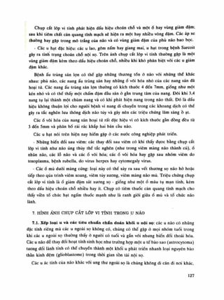Chụp cắt lóp vi tính phát hiện dấu hiệu choán chỗ và mộtố hay vùng giám đậm;
sau khi tiêm chất cản quang tĩnh mạch sẽ hiện ra một hay nhiều vòng đậm. Các áp xe
thường hay gặp trong mỏ trắng của não và có vùng giảm dậm của phù não bao bọc.
- Các u hạt đặc hiệu: các u lao, gôm nấm hay giang mai, u hạt trong bệnh Sarcoit
gây ra tình trạng choán chỗ nội sọ. Trên ảnh chụp cắt lóp vi tính thuồng gặp là mội
vùng giảm đậm kèm theo dấu hiệu choán chỗ, nhfêu khi khó phân biệt vói các u giảm
đậm khác.
Bệnh ấu trùng sán lọn có thể gặp những thương tổn ỏ náo vói nhũng thế khác
nhau: phù não, các nang ấu trùng sán hay nhũngổ vôi hóa nhò cùa các nang sán đã
hoại tử. Các nang ấu trùng sán lọn thường có kích thuốc 4 đến 7mm, giống nhu một
kén nhỏ và có thể thấy một chấm đậm đàu sán ỏ gần trung tâm cùa nang. Đôi khi 3,4
nang tụ lại thành một chùm nang và có khi phát hiện nang trong não thất. Đó là dấu
hiệu không thuận lọi cho nguôi bệnh vì nang di chuyền trong các khoang dịch có thề
gây ra tắc nghẽn lưu thông dịch não tủy và gây nên các triệu chúng lâm sàngồ ạt.
Cácổ vôi hóa của nang sán hoại tử rất đặc hiệu vì có kích thuốc gần đồng đều tù
3 đến 5mm và phân bố rải rác khắp hai bán càu não.
Các u hạt nói trên hiện nay hiếm gặp ỏ các nước công nghiệp phát triển.
- Nhũng biến đổi sau viêm: các thay đồi sau viêm có khi thấy đụoc bằng chụp cắt
lốp vi tính nhu não úng thủy thể tắc nghẽn (nhu trong viêm màng não thành củ),ổ
nhũn não, các lỗ não và các ổ vôi hóa; các ổ vôi hóa hay gặp sau nhóm viêm do
toxoplasma, bệnh rubella, do virus herpes hay cytomegaly virus.
- Cácổ mù đuôi màng cứng: loại này có thề xảy ra sau vết thương sọ não hò hoặc
tiếp theo qua trình viêm xoang, viêm tủy xuong, viêm màng não mủ. Triệu chúng chụp
cắt lóp vi tính' làổ giảm đâm sát xương sọ - giống nhu mộtổ máu tụ mạn tính, kèm
theo dấu hiệu choán chỗ nhiều hay ít. Chụp có tiêm thuốc cản quang tĩnh mạch cho
thấy viền tố chức hạt ngấm thuốc mạnh nhu là ranh giói giũa ổ mủ và tố chức não
lành.
7. HÌNH ẢNH CHỤP CẮT LÓP VI TÍNH TRONGụ NÃO
7.1. Xếp loại u và các tiêu chuẩn chẩn đoán khối u nội sọ: các u não có nhũng
dặc tính riêng mà các u ngoài sọ không có, chúng có thể gặp ỏ mọi nhóm tuổi trong
khi các u ngoài sọ thường thấy ỏ nguôi có tuổi và gắn vói nhung biến đổi thoái hóa.
Các u náo dễ thay dổi hoạt tính sinh học nhu truòng họp một u tế bào sao (astrocytoma)
tuông đối lành tính có thế chuyền thành một khối u phát triển nhanh loại nguyên bào
thần kinh đệm (glioblastome) trong thòi gian tồn tài nội sọ.
Các u ác tính của não khác vói ung thu ngoài sọ là chúng không di căn di noi khác.
127
 