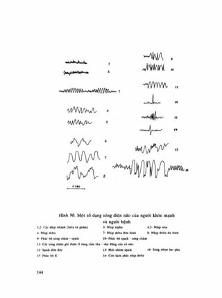 >MJ^K«tWiC ị
~vMWl/l/Vl/lMw*^^
VlA/VlMA 4
4/A//VyiA^ 5
A/V6
- y y y y v v i ,
í-*
i séc
Hình 90. Một số dạng sóng diện não của nguôi khỏe mạnh
và nguôi bệnh
1,2- Các nhịp nhanh (bela và gama) 3- Nhịp alpha 4,5- Nhịp teta
6- Nhịp delta 7- Nhịp delta đơn hình 8- Nhịp delta đa hình
9- Phức bộ sóng chậm - spaik lo- Phức bộ spaik - sóng chậm
li- Các sóng chậm ghi được ỏ vùng cảm thụ - vân động cùa vò não
12- Spaik đơn độc 13- Một nhóm spaik 14- Sóng nhọn hai pha
15- Phức bộ K 16- Can kịch phái nhịp delta
144
 