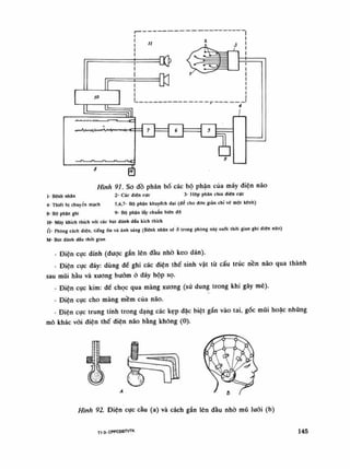 Hình 91. So dồ phân bố các bộ phận cùa máy diện não
Ì- Bệnh nhân 2- Các điện cực 3- Hộp phân chia điện cực
4- Thiết bi chuyên mạch 5.6,7- Bộ phận khuyéch đại (đè cho đòn giàn chi vẽ mội kênh)
8- Bộ phận ghi 9- Bộ phận lấy chuẩn biên độ
10- Máy khích thích vói các búi dành dâu kích thích
ri- Phòng cách điện, liếngổn và ánh sáng (Bệnh nhân sẽ à trong phòng này SUỐI thài gian ghi điện nào)
M- Búi đánh díu thòi gian
- Điện cục dính (được gắn lên đầu nhò keo dán).
- Điện cục đáy: dùng để ghi các điện thế sinh vật tù cấu trúc nền não qua thành
sau mũi hầu và xuong bướm ó đáy hộp sọ.
- Điện cục kim: để chọc qua màng xương (sử dung trong khi gây mê).
- Điện cục cho màng mềm của não.
- Điện cục trung tính trong dạng các kẹp đặc biệt gắn vào tai, góc múi hoặc nhúng
mô khác vói điện thế điện não bằng không (0).
Hình 92. Điện cục càu (a) và cách gắn lên đấu nhò mũ lưới (b)
TI 0- CPPCĐBTVTK 145
 