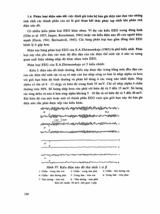 1.4. Phân loại diện náo đổ: việc đánh giá toàn bộ bản ghi diện não dựa vào nhũng
tính chất các thành phần của nó là giai đoạn kết thúc phúc tạp nhất khi phân lích
điện não đồ.
Có nhiều kiêu phân loại EEG khác nhau. Ví dụ: các kiểu EEG trong dộng kinh
(Gibs et ai. 1937; Jasper, Kerschman, 1941) hoác các kiểu điện não dồ của nguôi khỏe
mạnh )Davis, 1941; Beritashvili, 1943). Các bảng phân loại bao gồm dồng thòi EEG
bệnh lý ít gặp hon.
Hiện nay bảng phân loại EEG cùa E.A Zhirmunskaja (1963) là phổ biến nhất. Phân
loại này chủ yếu dựa vào mức độ đều đặn cùa các điện thế sinh vật ò náo và tương
quan xuất hiện nhũng nhịp độ khác nhau trên EEG.
Phân loại EEG của E.A.Zhirmunskaja có 5 kiêu chính:
• Kiểu, ì: điện não đồ bình thường. Kiểu này được đặc trưng bằng mức đều dãn cao
cùa các diện thế sinh vật và sụ có mặt của hai nhịp sóng co bàn là nhịp alpha và beta
vói giói hạn biên độ bình thuồng và phân bó đúng ỏ các vùng náo nhất định. Nhịp
alpha có tần số 8 - 13 ck/gy và biên độ trung bình 55 mcV. Chi số nhịp alpha ỏ chầm
thường trên 50%. Số lượng nhịp beta vừa phải với biên độ từ 5 đến 15 mcV. Sò luông
các sóng delta và teta ít hon sóng alpha khoảng 5 - 10 lần và có biên độ tù 5 đến 20 mcV.
Khi biên độ cùa một hoặc một số thành phàn EEG vượt qua giói hạn này thì bàn ghi
điện não càn phải được xếp vào kiều khác.
oe
lcenỊ 5ỌMV
ÓT
Hình 97. Kiểu điện não đồ thú nhất Ì a ệ
Ì- Châm - trung lâm trái 2- Châm - trung lam phải 3- Chàm - thái dương trái
4- Chàm - thái dương phái 5- Trung lâm - Iran trái 6- Trung tâm - trán phái
7- Thái dương - trán trái 8 - Thái dương - trán phái
Biên độ chuẩn: 50 mcV, thòi gianỉ giãy
Ĩ50
 
