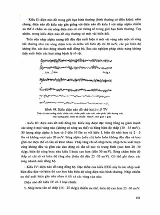 • Kiêu li: điện não dồ trong giói hạn bình thường (bình thuồng có điêu kiện): nhìn
chung, diện não đồ kiểu này gằn giống vói điện não đồ kiều ì vói nhịp alpha chiếm
ưu thế ỏ chẩm và các sóng diện náo có các thông số trong giói hạn bình thường. Tuy
nhiên, trong kiểu điện não đồ này thuồng có một vài biến đổi.
Trên nền nhịp alpha tuông đói đều đặn xuất hiện ỏ một vài vùng não một số sóng
bất thường nhu các sóng chậm teta và delta vói biên độ tói 30 mcV, các pic biên độ
không lòn, các dao động nhanh mất đồng bộ. Sau các nghiệm pháp chúc năng không
thấy xuất hiện các loại sóng bệnh lý rỗ rệt.
ỊlKỊ w *****
F
Hình 98. Kiều điện não đồ thứ hai 2 aậ TV
Tính từ trên xuống đuổi: chẩm trái; châm phải; trán trái; trán phải; thái dương trái;
thái dương phải. Biên độ chuẩn: SOmcV, thòi gian Ì giây
- Kiểu IU: điện não đồ mất đồng bộ. Kiều này được đặc trung bằng sụ giảm mạnh
các sóng ỏ mọi vùng não (không có sóng ưu thế) và bằng biên độ thấp (30 - 35 mcV).
Số lượng nhịp alpha ít hon từ 5 đến lo lần so vói kiểu ì, biên dô nhỏ hon tù 2 - 5
lần và không vượt qua 20 mcV. Sóng alpha (nếu có) luôn luôn không đều đặn và bao
gồm các điện thế có tần sổ khác nhau. Thấy tăng chi sổ nhịp beta, nhịp beta xuất hiện
cũng không đều và gồm các dao động có tần số cao và trung bình (cao hon 20 -30
ck/gy, biên độ sóng beta nhu kiểu ì hoặc cao hon (đến 30 mcV). Sóng chậm biên độ
thấp có chi số và biên độ tăng nhẹ (biên độ đến 25 -35 mcV). Có thể ghi được các
sóng nhanh mất dồng bộ.
- Kiểu IV: điện não đồ tăng đồng bộ. Đặc điểm cùa kiêu EEG này là các nhịp xuất
hiện đều đặn vói biên độ cao hon hẳn biên độ sóng điện não bình thuồng. Nhịp chiếm
ưu thế xuất hiện gần nhu nhau ỏ tất cả các vùng của não.
Điện náo đồ kiểu IV có 3 loại chính:
ì. Nhịp beta tàn số thấp (14 - 25 ck/gy) chiếm uu thế, biên độ cao hon 25 -30 mcV.
151
 