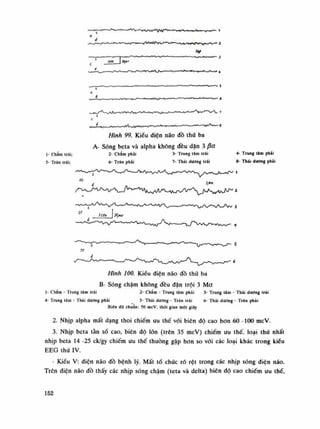 Hình 100. Kiểu điện não dồ thứ ba
B- Sóng chậm không đều đặn trội 3 Ma
Ì- Chấm - Trung tam trái
4- Trung tâm - Thái dương phải
2- Chấm - Trung tâm phải
5- Thái dương - Trán trái
3- Trung tâm - Thái dương trái
6- Thái dương - Trán phải
Biên độ chuân: 50 mcV. thòi gian một giây
2. Nhịp alpha mất dạng thoi chiếm liu thế vói biên độ cao hon 60 -100 mcV.
3. Nhịp beta tàn số cao, biên độ lỏn (trên 35 mcV) chiếm uu thế. loại thứ nhất
nhịp beta 14 -25 ck/gy chiếm liu thế thuòng gặp hon so vói các loại khác trong kiều
EEG thú IV.
- Kiêu V: điện não đồ bệnh lý. Mất tố chức rõ rệt trong các nhịp sóng diện não.
Trên diện não đồ thấy các nhịp sóng chậm (teta và delta) biên độ cao chiếm líu thế.
152
 