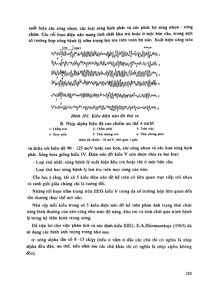 xuất hiện các sóng nhọn, các loạt sóng kịch phát và các phức bộ sóng nhọn - sóng
chậm. Các rói loạn điện não mang tính chất khu trú hoặc ỏ một bán cầu, trong một
số trường họp sóng bệnh lý tràm trọng lan tỏa trên toàn bộ não. Xuất hiện sóng teta
ta* so/nv
ồ Ạ
d
Hình loi. Kiều điện não đồ thứ tu
B- Nhịp alpha biên độ cao chiếm ưu thế 4 aaM
Ì- Chàm trái 2- Chàm phải 3- Trán trái;
4- Trán phải 5- Thái dương trái 6- Thái dương phái
Biên độ chuẩn : so mcV, thòi gian Ì giây
và delta vói biên độ 90 - 125 mcV hoặc cao hon, các'sóng nhọn và các loạt sóng kịch
phát. Sóng beta giống kiều IV. Điện não đồ kiểu V còn được chia ra hai loại:
- Loại thứ nhất: sóng bệnh lý xuất hiện khu trú hoặc chi ỏ một bán càu.
- Loại thú hai: sóng bệnh lý lan tỏa trên mọi vùng cùa não.
Càn lưu ý rằng, tất cả 5 kiểu điện não đồ kề trên có liên quan trực tiếp vói nhau
và ranh giói giữa chúng chi là tuông đối.
Những rối loạn tràm trọng trên EEG kiểu V trong đa số trường họp liên quan đến
tồn thương thục thể mô não.
Nhu vậy mỗi kiêu trong số 5 kiều điện não đồ kế trên phản ánh trạng thái chức
năng bình thuòng của não cũng nhu mức độ nặng, khu trú và tính chất qua trình bệnh
lý trong hệ thằn kinh trung ương.
Đế tiện loi cho việc phân tích và xác định kiều EEG , E.A.Zhirmunskaja (1963) dã
sử dụng các hình ảnh tượng trung nhu sau:
a: sóng alpha tần số 8 -13 ck/gy (nếu a nằm ó đàu các chú thì có nghĩa là nhịp
alpha đều đặn, ưu thế; nếu nằm sau các chữ khác thì có nghĩa là nhịp alpha không
đều).
153
 