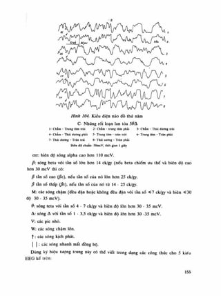 8
Hình 104. Kiểu diện não đồ thú năm
C- Những rối loạn lan tòa 5ỚA
Ì- Chẩm - Trung tâm trái 2- Chẩm - trung lâm phải 3- Chẩm - Thái dương trái
4- Châm - Thái dương phải 5- Trung tâm - trán trái 6- Trung tâm - Trán phái
7- Thái dương - Trán trái 8- Thái sương - Trán phải
Biên độ chuẩn: 50mcV, thòi gianỉ giãy
aa: biên độ sóng alpha cao hon no mcV.
ậ: sóng beta vói tần số lốn hon 14 ck/gy (nếu beta chiếm liu thế và biên độ cao
hon 30 mcV thì có:
p tàn số cao (/Se), nếu tàn số cùa nó lòn hon 25 ck/gy.
ậ tần số thấp (ật), nếu tằn số của nó từ 14 - 25 ck/gy.
M: các sóng chậm (đều đặn hoặc không đều đặn vói tần số «7 ck/gy và biên sỉ 30
độ 30 - 35 mcV).
ớ: sóng teta vói tàn số 4 • 7 ck/gy và biên độ lớn hon 30 - 35 mcV.
A: sóng A vói tần số Ì - 3,5 ck/gy và biên độ lòn hon 30 -35 mcV.
V: các pic nhỏ.
W: các sóng chậm lòn.
t: các sóng kịch phát.
I I : các sóng nhanh mất đồng bộ.
Dùng ký hiệu tuông trung này có thề viết trong dạng các công thức cho 5 kiểu
EEG kế trên:
155
 