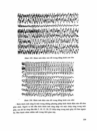 Hình 105. Hình ảnh điện não đồ trong động kinh con lòn
B Ì M /
7ỚỔ. Hình ảnh diện não đồ trong đông kinh con nhỏ
- Kích thích ánh sáng là một trong những phương pháp kích thích điện não dồ đon
giản nhất. Nguôi ta bắt đầu kích thích ánh sáng nhịp vói một chóp sáng trong một
giây sau đó lại tâng dần đến 5, 10, 15, 20, 25 chóp sáng trong một giây rồi làm ngược
lai. Bảo bênh nhân nhắm mắt trong thòi gian này.
159
 