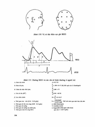 Hình HO. Vị trí dặt diện cực ghi REG
REO
ECG
Hình ni. Đường REG và các chi số bình thuòng ỏ nguôi trê
A=0,15 aA. Biên dô chính
B. Biên độ phụ.
B'. Biên độ chân dinh phụ.
a. Góc di lốn (80°)
ộ. Góc dinh chính
a. Thòi gian tim - nào (0,16 - 0.24 giây)
b. Thời gian đi lên cùa sóng (0.08 - 0,12 giây)
c. Thời gian đi xuống
d Thòi gian di xuống sau dinh phụ
T. Thòi gian loàn bộ sóng REG
- X 100=14-17 (K) Két quà cùa Lĩ-Sandrigaile
B
— xioo =75
A
R=i—=0,1-0,27
HA(lb)x60
v= -3.14+1.36K
x=280-350ml/lphúl
Y=0,2820x-3,2I54
X=h(gy)xl00 (Thòi gian luẩn hoàn
qua nỉo - 3,35-6 giây)
Thể tích máu qua một bán cáu não
184
 