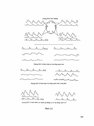 Dương REG binh thuổng
Dường REO à bênh nhân xơ vữa dộng mạch não
DưAng REO à bênh nhân lắc dộng mạch cảnh trong phái
ứưilng RKGỏ bênh nhân cao huyết áp khổng có xo vữa động mạch não
Hình 112
185
 