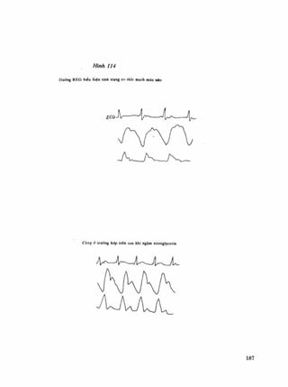 Cũng (ì irưÀng hợp trẽn sau khi ngâm nitroglycerin
187
 