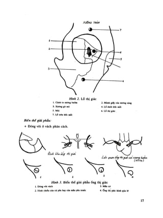 Hình 2. Lỗ thị giác
1. Cánh lo xương bướm 2. Mành giày của xương sàng
3. Xương gò má 4. Lố đuổi hốc mắt
5. Mũi 6. LỐ thị giác
7. Lã (ren hốc mắt
Biên thể giải phẫu:
+ Đóng vôi ỏ vách phân cách.
Hình 3. Biến thể giải phẫuống thị giác
I. Dóng vôi vách 3. Mỉu co
2. Hình chiếu cùa củ yên hay của máu yên trước 4.ống thị giác hình qủa lí
17
 