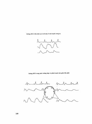 Dưdng REO biêu hiện sự ứ trệ máu đ lĩnh mạch trong sọ
Dường RF.G trong một trướng hợp có phình mạch não gifla bên phải
An À V U ^ W ÁT A A — ^ n - ^
188
 