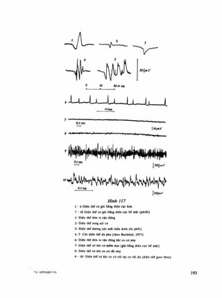 ~ 1
300jHự
0
lo tom Séc
• Ề
o,tec
0,isec
Ị < ^'(TH*1
n li v*l')«*
o,tut
*»"••" 1*1 Ị HH»»V»
Wìrt/I 7/7
Ì - 6 Diện thế cơ ghi bằng diện cực kim
7 - 10 Diện thế ca ghi bằng điện cực bể mặt (phiến)
Ì- Diên thế dơn vị vận dộng
2- Diện thế rung sợi cơ
3- Diện thế dưong (do mắt thẩn kinh chi phối)
4, 5- Các điên Ihé đa pha (theo Buchlhal. 1957)
6- Diện thế đốn vị vặn động khi co co nhẹ
7- Diện thè co khi co mém mại (ghi bằng diện cực bé mặt)
8- Diện thế cơ khi co cơ rít nhẹ
9 - 10- Diên thế cd khi co cổ vói lực co tối đa (điện thế giao thoa)
">3 - CPPCĐBTVTK 193
 