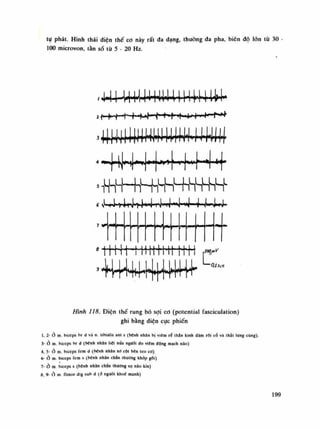 tụ phát. Hình thái diện thế co này rất đa dạng, thường đa pha, biên độ lòn từ 30
100 microvon, tàn số tù 5 - 20 Hz.
4 4 ị 4 4 ị ị ị t 4 4 ị U 4 4 4 ị ị ị ị ị l
3 ị ị 4 4 4 ị ị | 4 + W ị ị ị ) ị ị ị ị l 4
1 . . . . - 1 - ã .
• # f H M + H 4 f H 4 f +
í S^»-«f4l
-<
)rịTj><
>4^,
4,
'rJM
'l4'*4''w
l''4 1
J»lị»
a
t H + M m t t t t ì H i n
3<*|* r»*s*Ỷ*'ầ
*""*f
**'À
^r
OAscc
Hình 118. Điện thế rung bó sợi co (potential fasciculation)
ghi bằng điện cục phiến
Ì, 2-Ỏ m. biceps br d và n. libialis an! s (bệnh nhân bị viêm rễ thẩn kinh đám rồi cổ và thắt Ung c
3- ỏ m. biceps br d (hênh nhân liệt nửa người do viêm động mạch nào)
4, 5-Ỏ m. biceps fem d (bệnh nhản xo CỘI bên teo cơ)
6-Ỏ m. biceps fem s (bệnh nhân chán thương khớp gối)
7- ỏ m. biceps s (bệnh nhân chấn thương sọ nào kin)
8 9-ở m ílexor dig sub d (đ người khói mạnh)
199
 