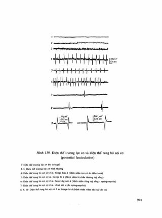 z Ị ẤỊ » HI 11 M1
Ạ 11
—l1
" 1
"1
"' ''111
* ụ
3 >T*Hwh nwmm*<Ệ|»»Miệ (»'Ịiw»n»ềv»»ii»
5 —ị—jp—Ị—Ị—^r—ị—Ị—ị—Ị—Ị——4—
, lị
ì " ì
t30ớ
«0.5 *c
Hình 119. Điện thế trương lục co và diện thế rung bó sợi co
(potential íasciculation)
Ì- Diện Ihé trương lực cữ khi co nghi
2, 3- Diện lhế (rương lực cd bình thuồng
4- Diên lhế rung bõ sợi cờ đ in. biceps fem d (bệnh nhân leo cờ do thắn kinh)
5- Diên thế rung bó sợi cơ m. biceps br d (bệnh nhân bị chán thuổng lũy sổng)
6- Diện thế rung bỏ sợi cơồ m. tlexor dig sub d (bệnh nhân rống lũy sổng - syringomyelia)
7- Diên Ihí rung bó sợi cơ ỏ m. lihial am s (do syríngomyelia)
8 9 10- Diên thế rung hò sợi cơ ỏ m. biceps br d (bệnh nhìn viêm náo lũy do ve)
201
 
