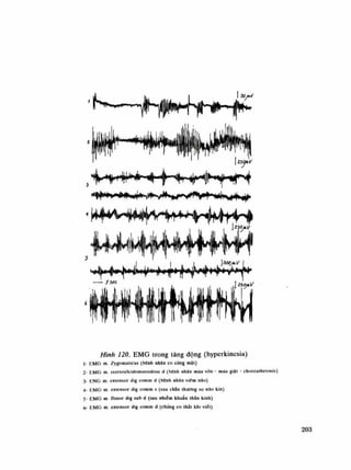 ••Mn»ii-t»»i|» i M K ^ ^ ^ v t - m l i v ắ l N ệ K
//ì/i/ỉ /2Ớ. EMG trong tăng động (hyperkinesia)
Ì- FMG m. Zygomaticus (bệnh nhân co cứng mặt)
2- EMG m. siernoclcỉdomatoĩđeus d (bệnh nhân múa vòn - múa giặt - choreathetosis)
3- ENG m. extensor dig comm d (bệnh nhân viốm não)
4- KMG m. exlensor dig comm s (sau chắn thương sọ não kin)
5- FMG m ílexor dig sub d (sau nhiễm khuân thần kinh)
6- EMG m. exlensor dìg comm d (chúng co thắt khi viết)
 