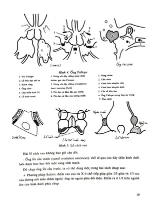 J r y ỵ u s ă m ® 1
w ( nmrz) Ỡnỹ FALLOPỄ
1. Vòi Fallope
2. Lô bầu dục mỏ ra
3. Ranh sổng
4.Ống cành
5. Dây thăn kinh IU
6. LỖ rách trước
Hình 4. Õng Fallope
I. Dóng vối dây chằng (nòm chăn
bướm- gai cùa Civinini
2. Dóng vôi dây chằng crotaphitico
bucci natorius Hyrth
3. Phì đại và dặm đặc gai bướm
4. Phì đại cù hầu của xương chàm
1. Hang chũm
2. Tiên dinh
3. Vành bán khuyên irín
4. Vành bán khuyên dưới
5. Cùa sô bầu dục
6.Ống Fallope trongống tai trong
7.Ốne cành
Ló rách Si,
^ 0
( Tưth truóc -Siu)
Hình 5. Lỗ rách sau
LsWch Ì
Hai lỗ rách sau không bao giò cân đối.
-Ống lồi càu trước (canal condylien anterieur): chỗ đi qua của dây thần kinh dưới
luõi dược bao bọc bài một vùng tính mạch.
Đế chụpống lồi càu truóc, ta có thề dùng một, trong hai cách chụp sau:
+ Phương pháp Salotti: điếm vào cùa tia X ỏ chỗ tiếp giáp giữa 1/3 giũa và 1/3 sau
của đường nối mấu chầm ngoài-ống tai ngoài phía đối diện. Điếm ra ò 1/3 trên ngành
lên của hằm đuôi phía chụp.
19
 