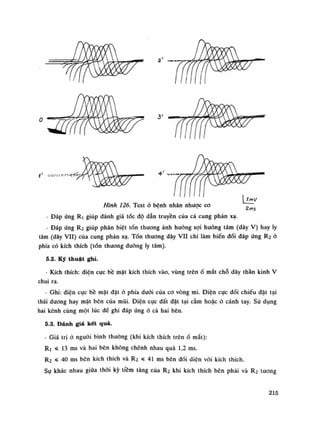 Hình 126. Test ò bệnh nhân nhược co
r
• 2/775- Đáp ứng Ri giúp đánh giá tốc độ dẫn truyền của cả cung phản xạ.
- Đáp ứng R.2 giúp phân biệt tốn thương ảnh huống sợi huống tâm (dây V) hay ly
tâm (dây VII) cùa cung phản xạ. Tổn thương dây v u chi làm biến đổi đáp ứng R2 ỏ
phía có kích thích (tổn thương đưòng ly tâm).
5.2. Ký thuật ghi.
- Kích thích: điện cục bề mặt kích thích vào, vùng trênố mắt chỗ dây thần kinh V
chui ra.
- Ghi: điện cục bề mặt dặt ò phía dưới của co vòng mi. Điện cục đối chiếu dặt tại
thái dương hay mặt bên của mũi. Điện cực đất đặt tại cằm hoặc ỏ cánh tay. Sù dụng
hai kênh cùng một lúc đế ghi đáp ứng ó cà hai bên.
5.3. Đánh giá kết quả.
• Giá trị ó người bình thường (khi kích thích trên ổ mắt):
Ri « 13 ms và hai bên không chênh nhau quá 1,2 ras.
R2 s 40 ms bẽn kích thích và R2 « 41 ms bên dối diện vói kích thích.
Sự khác nhau giũa thòi kỳ tiềm tàng của R2 khi kích thích bên phải và R.2 tuông
215
 