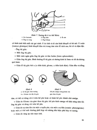 Hình 7. Xương đá ỏ tu thế Hirtz
ì. Vòi Eusiache 2. Óng cành 3. Óc sên
4. ng tai trong 5.Ống Fallope
CÓ hình ảnh biến mất các gai cảnh. u ác tính và di căn hình khuyết có bò mò. u cuộn
(tumeur glomique) hình khuyết khu trú trung tâm trên lỗ rách sau, bò rõ và đậm đặc.
- Ong thị giác:
+ Mấtống thị giác.
+ Mất vách ngăn giũa óng thị giác và khe bướm (fente sphenoidale).
+ Giãnống thị giác. Bình thuồng lỗ thị giác có đường kính là Smm và tối đa không
quá 6mm.
+ Giãn lỗ thị giác bói u (u thần kinh, gliome, u thần kinh đệm). Giãn đều và-đồng
Hình 8
a- LỐ thi giác bình thường
b-c. Gliome cùa dây thị giác
Hình 9
Hố yên oméga trong gliomc cùa
giao thoa thị giác
tâm, có thể có đóng vôi ò trên hò yên hoặc có hình hố yên thành chữ oméga.
+ Giãn do Glome của giao thoa thị giác: hố yên hình omega vói khả năng xâm lấn
ống thị giác và đóng vôi trên hố yên.
+ Giãn do sự xâm lấn của một u tuyến yên, cùa một u sọ hàu (cranio- pharyngiome)
hoặc một.u ỏ hố mắt thường phối họp vói nhũng dấu hiệu phá hủy vỏ xương.
+ Giãn do tăng áp não mạn tính.
21
 