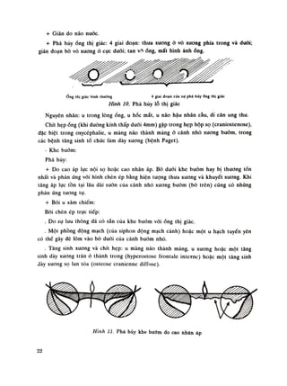 + Giãn do não nước.
+ Phá hủyống thị giác: 4 giai đoạn: thua xương ỏ vỏ xương phía trong và đuối;
gián đoạn bò vỏ xương ỏ cục đuôi; tan vf)ống, mất hình ảnh ống.
ống thị giác binh thường 4 giai đoạn của sự phá hủyổng thi giác
Hình 10. Phá hủy lỗ thị giác
Nguyên nhân: u trong lòngống, u hóc mắt, u não hậu nhăn cầu, di căn ung thu.
Chít hẹp óng (khi dường kính thấp đuôi 4mm) gặp trong hẹp hộp sọ (cranỉostenose),
đặc biệt trong oxycéphalie, u màng não thành mảng à cánh nhỏ xương bướm, trong
các bệnh tăng sinh tổ chức làm dày xương (bệnh Paget).
- Khe buốm:
Phá húy:
+ Do cao áp lục nội sọ hoặc cao nhãn áp. Bò đuối khe bướm hay bị thương tổn
nhất và phản ứng với hình chèn ép bằng hiện tượng thua xương và khuyết xương. Khi
tăng áp lục tồn tại lâu dài suôn cùa cánh nhó xuong buóm (bò trên) cũng có nhũng
phàn ứng tuông tụ.
+ Bài u xâm chiếm:
Bời chèn ép trục tiếp:
. Do sụ lưu thông đã có sẵn của khe bướm vóiống thị giác.
. Một phồng động mạch (cùa siphon động mạch cảnh) hoặc một u hạch tuyến yên
có thể gây dè lõm vào bò đuôi của cánh bướm nhỏ.
. Tăng sinh xương và chít hẹp: u màng não thành mảng, u xương hoặc một tăng
sinh dày xương trán ỏ thành trong (hyperostoseừontale intetnc) hoặc một tăng sinh
dày xuong sọ lan tòa (osteose cranienne diffnse).
Hình li. Phá hủy khe bướm do cao nhãn áp
22
 