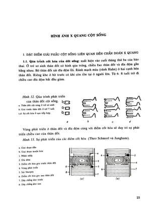 HÌNH ẢNH X QUANG CỘT SONG
1. ĐẶC ĐIỂM GIẢI PHẪU CỘT SỐNG LIÊN QUAN ĐẾN CHẨN ĐOẤN X QUANG
1.1. Qua trình cốt hóa của dốt sống: xuất hiện vào cuối tháng thứ ba của bào
thai.Ỏ trẻ so sinh thân đốt có hình qua trứng, chiêu Cao thân đốt và đĩa đệm gần
bằng nhau. Bò thân đốt sát đĩa đệm lồi. Rãnh mạch máu (rãnh Hahn) ỏ hai cạnh bên
thân dốt. Riêng khe ỏ bò trước có khi còn tồn tại ỏ nguôi lòn. Từ 6- 8 tuổi trỏ đi
chiều cao đĩa đệm bắt đàu giảm.
Hình 12. Qua trình phát triển
của thân đốt cột sóng. ^y—^
a Thân dốt cột sóng đ trê sờ sinh
b. Góc trước thân đốt à trẻ 7 tuổi
c,d. Sự cót hóa đ sụn tiếp hợp.
Vùng phát triển ỏ thân đốt và đĩa đệm cùng vói điểm cót hóa sẽ duy trì sụ phát
triển chiều cao của thân đốt.
Hình 13. Sụ phát triển cùa các điểm cót hóa (Theo Schmorl và Junghans).
a. Giai đoạn đẩu
b. Giai đoạn muộn hon
1. Nhân nhẩy
2. Dĩa đệm
3. Diêm CỐI hóa góc irưóc thân đổi
4. Vùng phát triển
5. sợi Sharpey
6 Diêm cốt hóa góc sau Ihân đối
7. Dây chằng dọc imớc
8. Dây chằng dọc sau
23
 