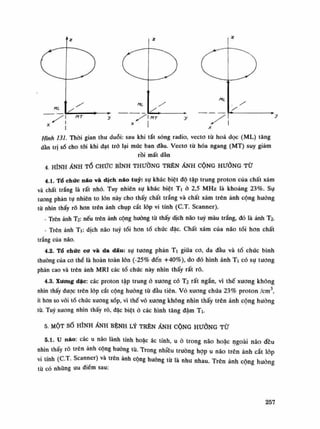 y
Hình 131. Thòi gian thu duỗi: sau khi tắt sóng radio, vecto tù hoa dọc (ML) tăng
dần trị số cho tói khi đạt trỏ lại mức ban đầu. Vecto từ hóa ngang (MT) suy giảm
rồi mất dần
4. HÌNH ẢNH TỔ CHỨC BÌNH THƯỜNG TRÊNẢNH CỘNG HƯỞNG TỪ
4 Ì TỔ chức náo và dịch não tuy: sụ khác biệt độ tập trung proton của chất xám
và chất trắng là rất nhỏ. Tuy nhiên sự khác biệt Ti ỏ 2,5 MHz là khoảng 23%. Sụ
tuông phản tụ nhiên to lốn này cho thấy chất trắng và chất xám trên ảnh cộng hướng
từ nhìn thấy rõ hon trên ảnh chụp cắt lóp vi tính (C.T. Scanner).
• Trên ảnh T2: nếu trên ảnh cộng huống tù thấy dịch não tuy màu trắng, đó là ảnh T2.
- Trên ảnh Ti: dịch não tuy tối hon tổ chúc đặc. Chất xám của não tối hon chất
trắng của não.
4.2. TỔ chức cơ và da đẩu: sự tuông phản Ti giũa co, da đầu và tổ chức bình
thuồng của co thề là hoàn toàn lớn (-25% đến +40%), do đó hình ảnh Ti có sụ tuông
phàn cao và trên ảnh MRI các tổ chức này nhìn thấy rất rõ.
4.3. Xương dặc: các proton tập trung ò xương có T2 rất ngắn, vì thế xương không
nhìn thấy được trên lóp cắt cộng huống tù đầu tiên. vỏ xuong chứa 23% proton /em3
,
ít hon so vói tổ chức xương xốp, vì thế vỏ xương không nhìn thấy trên ảnh cộng huỏng
tù. Tuy xuong nhìn thấy ró, đặc biệt ỏ các hình tăng đậm Ti.
5. MỘT SỐ HÌNH ẢNH BỆNH LÝ TRÊN ẢNH CỘNG HƯỞNG TỪ
5.1. u náo: các u não lành tính hoặc ác tính, u ò trong não hoặc ngoài não đều
nhìn thấy ró trên ảnh cộng huống tù. Trong nhiều trường họp u não trên ảnh cắt lóp
vi tính (C.T. Scanner) và trên ảnh cộng huỏng tù là nhu nhau. Trên ảnh cộng huống
tù có nhũng uu diêm sau:
257
 