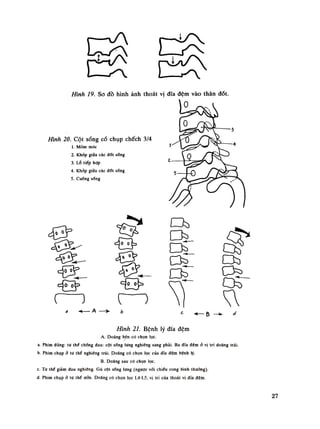 ( — y 
Hình 19. So đồ hình ảnh thoát vị đĩa đệm vào thân đốt.
Hình 20. Cột sống cổ chụp chếch 3/4
1. Mõm móc
2. Khớp giữa các đốt sống
3. LỐ tiếp hợp
4. Khớp giữa các đốt sống
5. Cuống sống
Hình 21. Bệnh lý đĩa đệm
A. Đoàng bên có chọn lọc.
a. Phim đứng: tư thế chổng đau: cột sống lưng nghiêng sang phải. Ba đĩa đệm ỏ vị trí đoảng trái.
b. Phim chụpở lư thế nghiêng trái. Đoảng có chọn lọc cùa đĩa đệm bệnh lý.
B. Doãng sau có chọn lọc.
c. Tư thế giảm đau nghiêng. Gù cột sống lưng (ngược với chiêu cong bình Ihưòng).
d. Phim chụp ỏ tư thế ưỡn. Đoàng có chọn lọc L4-L5, vị trí cùa thoái vị đĩa đệm.
27
 