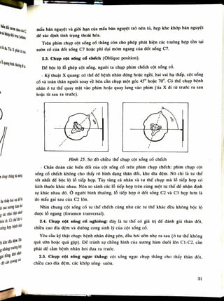 mấu bán nguyệt và giới hạn của mấu bán nguyệt trỏ nên tù, hẹp khe khôp bán nguyệt
dể xác định tình trạng thoái hóa.
Trên phim chụp cột sống cố thẳng còn cho phép phát hiện các trường họp tồn tại
suôn cổ của dốt sống C7 hoặc phì dại mỏm ngang cùa đốt sống C7.
2.3. Chụp cột sống cổ chếch (Oblique position).
Để bộc lộ lỗ ghép cột sóng, nguôi ta chụp phim chếch cột sống cổ.
- Kỹ thuật X quang: có thế để bệnh nhân dứng hoặc ngồi, hai vai hạ thấp, cột sóng
cổ và toàn thân nguôi xoay về bên cần chụp một góc 45° hoặc 70°. Có thế chụp bệnh
nhân ỏ tu thế quay mặt vào phim hoặc quay lung vào phim (tia X di tù trước ra sau
hoặc từ sau ra trước).
Hình 25. So đồ chiều thế chụp cột sống cố chếch
- Chấn đoán các biến dổi cùa cột sống cổ trên phim chụp chếch: phim chụp cột
sống cổ chếch không cho thấy rõ hình dạng thân dốt, khe đĩa đệm. Nó chi là tu thế
tốt nhất dế bộc lộ lỗ tiếp họp. Tùy tùng cá nhân và tu thế chụp mà lỗ tiếp họp có
kích thuốc khác nhau. Nên so sánh các lỗ tiếp họp trên cùng một tu thế đề nhận định
sụ khác nhau dó. Ổ nguôi bình thường, lỗ tiếp họp ó đốt sống C2 và C3 hẹp hon là
do mấu gai sau của C2 lòn.
Nhìn chung cột sống cố tư thế chếch cũng nhu các tu thế khác đêu không bộc lộ
được lỗ ngang (íoramen tranversal).
2.4. Chụp cột sống cổ nghiêng: đây là tu thế có giá trị đề đánh giá thân dốt,
chiêu cao dĩa đệm và đường cong sinh lý của cột sóng cổ.
Yêu càu kỹ thật chụp: bệnh nhân dứng yên, đầu hoi ưỡn nhẹ ra sau (ỏ tu thế không
quá uốn hoặc quá gập). Để tránh sụ chồng hình của xương hàm đuôi lên C1-C2, càn
phải đế cằm bệnh nhân hoi dưa ra trước.
2.5. Chụp cột sõng ngực thẳng: cột sống ngục chụp thẳng cho thấy thân đốt,
chiêu cao dĩa đệm, các khớp sống- suôn.
31
 