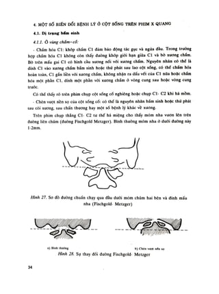 4. MỘT SỐ BIẾN DỔI BỆNH LÝỞ CỘT SỐNG TRÊN PHIM X QUANG
4.1. Di trạng bẩm sinh
4. Ị. 1. Ổ vùng chẩm- cổ:
- Chẩm hóa Cl: khóp chẩm Cl đàm bảo động tác gục và ngừa đàu. Trong trường
họp chấm hóa Cl không còn thấy đường khốp giói hạn giũa Cl và bò xuơng chấm.
Bò trên mấu gai Cl có hình càu xuong nối vói xuong chẩm. Nguyên nhân có thể là
dính Cl vào xương chẩm bầm sinh hoặc thứ phát sau lao cột sống, có thế chấm hóa
hoàn toàn, Cl gắn liền vói xuong chẩm, không nhận ra dấu vết của Cl nữa hoặc chẩm
hóa một phần Cl, dính một phần với xương chấm ỏ vòng cung sau hoặc vòng cung
trước.
Có thế thấy ró trên phim chụp cột sống cổ nghiêng hoặc chụp Cl- C2 khi há mồm.
- Chèn vượt nền sọ của cột sóng cổ: có thể là nguyên nhân bấm sinh hoặc thứ phát
sau còi xuong, sau chấn thương hay một số bệnh lý khác vê xương.
Trên phim chụp thẳng Cl- C2 tư thế há miệng cho thấy mỏm nha vuon lên trên
dường liên chũm (đuòng Fischgold Metzger). Bình thuồng mỏm nha ỏ dưới duòng này
l-2mm.
a) Bình thường b) Chèn vượt nén sọ
Hình 28. Sụ thay đối duòng Fischgold- Metzger
34
 