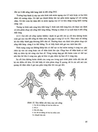 tồn tại 4 dốt sóng thắt lung tính tù đốt sống D12.
Truông họp bệnh lý này tạo nên hình ảnh móm ngang của L5 một hoặc cả hai bên
dính vói xương chậu. Có thể tạo thành khớp tân tạo giữa mỏm ngang L5 vói xương
chậu. Có khi toàn bộ thân đốt và mỏm ngang của L5 và hòa nhập trong khói xuong
cùng- cụt.
Tuông tụ hình ảnh cùng hóa thắt lung 5, hình ảnh thắt lung hóa chi được xác định
rõ trên phim chụp cột sống thắt lung thẳng. Nhung ta nhận ró sụ xuất hiện 6 dốt sóng
thắt lưng.
4.1.5. Gai đôi cột sóngịspina biỊida): danh tù gai đôi chì sụ cốt hóa không hoàn
toàn gai sau của đốt sóng do bầm sinh, hay gặp ỏ vùng L5 và SI. Theo một số thống
kê cho thấy: bệnh gặp khoảng 20% dân số. Thường được xác định trên phim chụp cột
sóng thắt lung- cùng ỏ tu thế thẳng. Ta sẽ thấy hình ảnh gai sau tách làm đôi.
Tình trạng cung sau không khép kín có thế tạo ra hai móm xương ó cung sau, gây
chèn ép vào túi cùng hoặc các rễ thần kinh lân cận. Chụp bao rễ thần kinh có thề
thấy sụ chèn ép túi cùng của bao ré. Vùng tuông úng gai đôi hoàn toàn có thế tạo
nên khe hò lòn ỏ cung sau, gây xo hóa và gây chèn ép bao rẽ ỏ vùng này.
Sụ cốt hóa không hoàn chinh của cung sau trong quá trình phát triền đôi khi dể
lại các điếm cốt hóa. Có thể thấy rõ trên phim chụp X quang, đó là các nốt mò cản
quang rát đậm nằm ỏ gai sau giữa vùng khe hà cùa gai đôi.
Hình 32. Sáu điềm cốt hóa của cột sống
1. Gai đôi do khống CỐI hóa hai điểm sau
2. Hà eo
3. Nưa đốt sống
4. Gai đoi đo khổng cốt hóa hai điểm (rước
5-6. Khuyết thân đốt
37
 