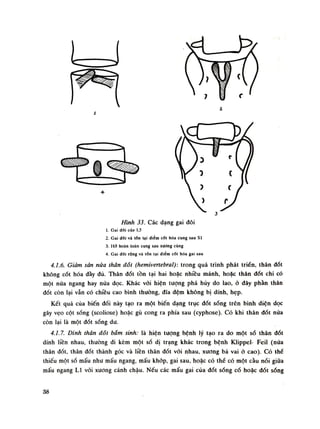 2
í
Hình 33. Các dạng gai đôi
1. Gai dổi cùa L5
2. Gai dũi và tổn lại điểm cốt hóa cung sau SI
3. Hò hoàn toàn cung sau xương cùng
4. Gai dổi rộng và lổn tại điểm cốt hóa gai sau
4.7.6. Giảm sản nữa thân dõi (hemivertebraiy. trong quá trình phát triền, thân dốt
không cốt hóa đầy đủ. Thân đốt tồn tại hai hoặc nhiều mảnh, hoặc thân dốt chi có
một nửa ngang hay nửa dọc. Khác vói hiện tượng phá hủy do lao, ỏ dây phần thân
đốt còn lại vẫn có chiều cao bình thường, đĩa đệm không bị dính, hẹp.
Kết quả cùa biến dổi này tạo ra một biến dạng trục dốt sống trên bình diện dọc
gây vẹo cột sống (scoliose) hoặc gù cong ra phía sau (cyphose). Có khi thân dốt nửa
còn lại là một đốt sóng du.
4.1.7. Dính thân dát bám sinh: là hiện tượng bệnh lý tạo ra do một so thân dốt
dính liền nhau, thuồng di kèm một số dị trạng khác trong bệnh Klippel- Feil (nửa
thân dốt, thân đốt thành góc và liền thân dốt vói nhau, xương bả vai ỏ cao). Có thể
thiếu một số mấu nhu mấu ngang, mấu khớp, gai sau, hoặc có thể có một càu nói giũa
mấu ngang LI vói xuong cánh chậu. Nếu các mấu gai của đốt sống cổ hoặc dốt sống
38
 