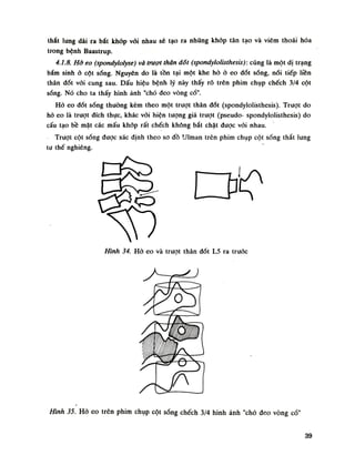 thắt lung dài ra bắt khóp vối nhau sẽ tạo ra những khớp tân tạo và viêm thoái hóa
trong bệnh Baastrup.
4.1.8. Hớ eo (spondylolyse) và trượt thăn đốt (spondylolisthesis): cũng là một dị trạng
bẩm sinh ỏ cột sống. Nguyên do là tồn tại một khe hở ò eo đốt sống, nối tiếp liền
thân đốt vói cung sau. Dấu hiệu bệnh lý này thấy rõ trên phim chụp chếch 3/4 cột
sóng. Nó cho ta thấy hình ảnh "chó đeo vòng cổ".
Hò eo đốt sóng thuồng kèm theo một trượt thân đát (spondylolisthesis). Truọt do
hò eo là trượt đích thục, khác vói hiện tuông giả trượt (pseudo- spondylolisthesis) do
cấu tạo bề mặt các mấu khớp rất chếch không bắt chặt được vói nhau.
Trượt cột sống được xác định theo so đồ Ulman trên phim chụp cột sóng thắt lưng
tư thế nghiêng.
Hình 35. Hò eo trên phim chụp cột sống chếch 3/4 hình ảnh "chó đeo vòng cổ"
Hình 34. Hò eo và trượt thân đốt L5 ra truóc
39
 