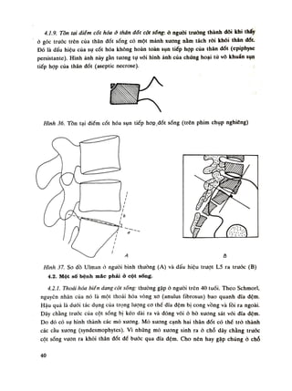 4.1.9. Tòn tại điềm cót hóa ờ thân đổi cột sổng: ỏ nguôi truồng thành dôi khi thấy
ò góc trước trên của thân đốt sống có một mảnh xuong nằm tách ròi khỏi thân dốt.
Đó là dấu hiệu của sụ cốt hóa không hoàn toàn sụn tiếp họp của thân dốt (epiphyse
persistante). Hình ảnh này gần tuông tụ vói hình ảnh của chúng hoại tủ vô khuẩn sụn
tiếp họp cùa thân đốt (aseptic necrose).
Hình 36. Tồn tại điếm cót hóa sụn tiếp hóp.dốt sóng (trên phim chụp nghiêng)
Hình 37. So đồ Ulman ỏ nguôi bình thường (A) và dấu hiệu trượt L5 ra trước (B)
4.2. Một số bệnh mác phải ò cột sống.
4.2.1. Thoái hóa biến dạng cột sóng: thuòng gặp ò nguôi trên 40 tuổi. Theo Schmorl,
nguyên nhân của nó là một thoái hóa vòng xo (anulus nbrosus) bao quanh đĩa đệm.
Hậu quả là dưới tác dụng cùa trọng lượng co thế đĩa đệm bị cong vồng và lồi ra ngoài.
Dây chằng truóc của cột sống bị kéo dài ra và đóng vôi ò bò xương sát vói dĩa đệm.
Do dó có sụ hình thành các mỏ xương. Mò xương cạnh hai thân dốt có thế trò thành
các càu xương (syndesmophytes). Vì những mỏ xương sinh ra ỏ chỗ dây chằng truóc
cột sống vươn ra khói thân dốt để bước qua dĩa đệm. Cho nên hay gặp chúng ỏ chỗ
40
 