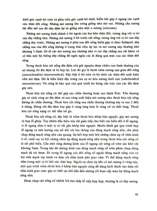 đuối góc cạnh bò trên và phía trên góc cạnh bò đuôi, hiếm khi gặp ỏ ngang các cạnh
cùa thân đốt sóng. Nhũng mỏ xương lốn trông giống nhu mỏ vẹt. Nhũng càu xương
lúc đầu mò sau dó dày đậm lại và gióng nhu một u xuong (osteome).
Những mỏ xương hình thành ỏ bò ngoài của hai bên thân đốt, tuông ứng với vị trí
cùa dây chằng bên. Nhũng mỏ xương ỏ bò trước cột sống, tuông ứng vói vị trí của dây
chằng dọc truóc. Những mỏ xương ỏ phía sau đốt sóng hiếm gặp vì theo Schmorl: dây
chằng sau của dốt sống không ỏ trạng thái chịu áp lục và mò xương này thường nhỏ
khoảng l-2mm. Sò dĩ các mỏ xương sau thuồng nhỏ vì các dây chằng sau rất khỏe và
có hẳn một hệ thống dây chằng để ngăn ngừa các di động quá múc cùa các thân đốt
sống.
Trong thoái hóa cột sống dĩa đệm còn giũ nguyên dược chiêu cao bình thường của
nó nhung rồi dĩa đệm sẽ bị hẹp lại. Lúc đó gọi là bệnh viêm xương sụn gian đốt sống
(osteochondrite intervertebral). Đặc biệt ò bò trên và bò đuôi các thân đốt xuất hiện
viền mò đậm. Đó là biếu hiện đặc trung cùa sụ xo hóa xương đuối sụn (subchondral
osteosclerose). Và cũng là hậu quả của quá trình hu hỏng cấu trúc của các dĩa đệm
gây nên.
Thoái hóa cột sống có thề gặp sau chấn thương hoặc sau bệnh Pott. Tổn thương
gây xé rách vòng xo đĩa đệm và sau cũng xuất hiện mỏ xuong nhu thoái hóa cột sống
không do chấn thương. Thoái hóa cột sóng sau chấn thương thuồng xảy ra sau 2 đến
6 tháng. Đóng vôi đĩa đệm hay gặp ỏ vùng lung hon là vùng cố và thắt lung. Thoái
hóa cột sống nặng có thể dẫn tói gù.
Thoái hóa cột sống cổ, đặc biệt là viêm thoái hóa khớp bán nguyệt, gây mó xương
và hẹp lỗ ghép. Tuy nhiên dấu hiệu này chi gián tiếp cho biết các biến đối ò lỗ ngang,
vì lỗ ngang nằm ỏ một vị trí rất gàn khớp bán nguyệt. Muốn đánh giá qua trình hẹp
lỗ ngang và ánh hường cùa nó đối vói lưu thông cùa động mạch sống nền, càn phải
chụp dộng mạch sống nền càn quang. Sụ kết họp một hội chúng chèn ép rễ thần kinh
ỏ cổ, cánh tay và hội chứng chèn ép động mạch sống nền trong thoái hóa cột sống cố
là rất phố biến. Cần nhó rằng đường kính cùa lỗ ngang cột sống cố trên xác khô chi
khoảng 5mm. Trong khi đó đường kính của động mạch sống cố trên phim chụp dộng
mạch đã tói 4mm. Đi trong lỗ ngang của đốt sống cổ ngoài động mạch sống còn có
hai tĩnh mạch tùy hành và đám rối thần kinh phó giao cảm. Vì thế động mạch sống
nằm trong một vị trí hết sức chật hẹp. Ngoài sụ chèn ép khi có mỏ xương ỏ vùng này,
một quá trình viêm thoái hóa ỏ khớp bán nguyệt cũng dễ dàng kích thích vào dám rói
thần kinh giao cám, gáy co thắt tại chỗ dẫn đến nhũng rối loạn cấp máu hệ động mạch
sống nền.
Phim chụp cột sống cổ chếch 3/4 cho thấy lỗ tiếp họp hẹp, thường là có dày xuong,
41
 