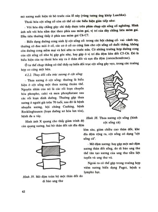 mó xương xuất hiện tù bò truốc của lỗ này (vùng tuông úng khóp Luschka).
Thoái hóa cột sóng cố còn có thế có các biếu hiện gián tiếp nhu:
- Vôi hóa dây chằng gáy: chi thấy được trên phim chụp cột sóng cố nghiêng. Hình
ảnh nót vôi hóa nằm dọc theo phía sau mỏm gai, vị trí của dây chằng liên mỏm gai.
Đầu tiên thuồng thấy ò phía sau mỏm gai C6-C7.
- Biến dạng đuòng cong sinh lý cột sống cổ: trong các hội chúng cổ- vai- cánh tay,
thuồng có đau mỏi ỏ cổ, các co ỏ cổ co cứng làm cho cột sóng cổ duỗi thẳng, không
còn đuòng cõng mềm mại và hoi uỡn ra truóc nữa. Có những truồng họp duòng cong
của cột sống cổ nhu bị gập góc nhẹ, hay gặp ỏ vị trí đĩa đệm liên đốt C5-C6. Đó là
biểu hiện cua sụ thoái hoa xay ra ỏ thân đốt và sụn dĩa đệm (osteschondrose).
Ỏ tu thế chụp thẳng có thè thấy sụ biến đổi trục cột sóng gây vẹo, trong các trưòng
họp co cứng một bên.
4.2.2. Thay dổi cấu trúc xươngở cột sống:
- Thua xương ỏ cột sóng: thuồng là biếu
hiện ỏ cột sống một thua xương thoăn thể.
Nguyên nhân của nó là các rói loạn chuyến
hóa phospho, calci và men phosphatase sau
các rói loạn dinh dưỡng. Thuồng gặp thưa
xuong ỏ nguôi già trên 70 tuổi, sau đó là bệnh
nhuyễn xương, hội chứng Cushing, bệnh
Recklinghausen (loạn duõng xo hóa lan tỏa),
bệnh đa u tủy.
Hình ảnh X quang cho thấy giảm trình độ
cản quang xương, hai bò thân đốt sát đĩa đệm
lõm sâu, giảm chiều cao thân đốt, khe
dĩa đệm rộng ra, cột sống có dạng "cột
sóng cá".
• Mò đậm xương: hay gặp một mò đậm
xương thân đốt sống, do di bào ung thu
thể tân tạo xương của ung thu tiền liệt
tuyến và ung thu vú.
Ngoài ra có thể gặp trong trường họp
viêm xương biến dạng Paget, bệnh u
lympho hạt.
Hình 38. Thua xương cột sống (hình
cột sóng cá)
à >
<
Hình 39. Mò đậm toàn bộ một thân đốt do
di bào ung thư
42
 