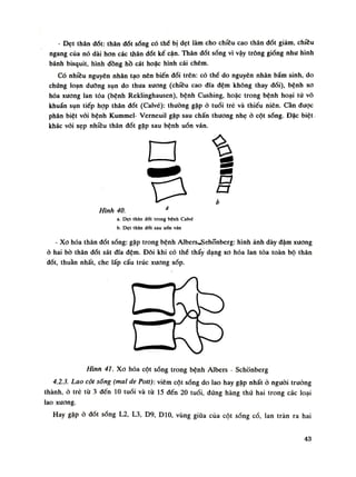 - Dẹt thân đốt: thân đốt sóng có thể bị dẹt làm cho chiêu cao thân đốt giảm, chfêu
ngang cùa nó dài hon các thân đốt kế cận. Thân đốt sống vì vậy trông gióng nhu hình
bánh bisquit, hình đồng hồ cát hoặc hình cái chêm.
Có nhiều nguyên nhân tạo nên biến đổi trên: có thề do nguyên nhân bầm sinh, do
chúng loạn dưỡng sụn do thua xương (chiều cao đĩa đệm không thay đồi), bệnh xo
hóa xương lan tỏa (bệnh Reklinghausen), bệnh Cushing, hoặc trong bệnh hoại tử vô
khuẩn sụn tiếp họp thân đốt (Calvé): thường gặp ỏ tuồi trẻ và thiếu niên. Cần được
phân biệt vôi bệnh Kummel- Verneuil gặp sau chấn thương nhẹ ò cột sống. Đặc biệt
khác vói xẹp nhiều thân đốt gặp sau bệnh uốn ván
•
Hình 40.a
a. Dẹt thân đổi trong bệnh Calvé
b. Dẹt thân đốt sau uốn ván
- Xo hóa thân đốt sóng: gặp trong bệnh Albere^Schonberg: hình ảnh dày đậm xương
ò hai bò thân đốt sát đĩa đệm. Đôi khi có thể thấy dạng xo hóa lan tỏa toàn bộ thân
đốt, thuần nhất, che lấp cấu trúc xương xốp.
Hinn 41. Xo hóa cột sống trong bệnh Albers - Schổnberg
4.2.3. Lao cột sóng (mai de Potí): viêm cột sống do lao hay gặp nhất ò nguôi truồng
thành, ỏ trẻ tù 3 đến 10 tuổi và tù 15 đến 20 tuồi, dứng hàng thứ hai trong các loại
lao xương.
Hay gặp ỏ dốt sóng L2, L3, D9, D10, vùng giũa cùa cột sóng cổ, lan tràn ra hai
a
43
 