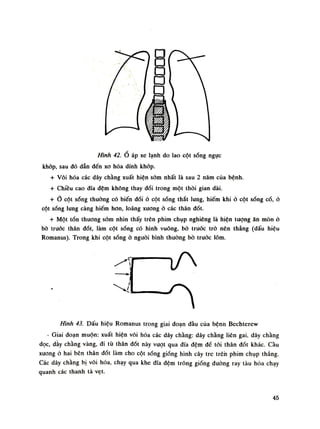 Hình 42. Ổ áp xe lạnh do lao cột sống ngục
khớp, sau đó dẫn đến xo hóa dính khỏp.
+ Vôi hóa các dây chằng xuất hiện sòm nhất là sau 2 năm của bệnh.
+ Chiều cao đĩa đệm không thay dổi trong một thòi gian dài.
+ cột sống thuồng có biến đổi ỏ cột sống thắt lung, hiếm khi ỏ cột sống cổ, ỏ
cột sống lung càng hiếm hon, loãng xương ỏ các thân đốt.
+ Một tổn thương sòm nhìn thấy trên phim chụp nghiêng là hiện tượng ăn mòn ỏ
bò trước thân đốt, làm cột sống có hình vuông, bò trước trò nên thẳng (dấu hiệu
Romanus). Trong khi cột sóng ỏ nguôi bình thường bò trước lõm.
Hình 43. Dấu hiệu Romanus trong giai đoạn dầu của bệnh Bechterevv
- Giai đoạn muộn: xuất hiện vôi hóa các dây chằng: dây chằng liên gai, dây chằng
dọc, dày chằng vàng, đi tù thân đốt này vượt qua dĩa đệm dế tói thân đốt khác. càu
xương ỏ hai bên thân đốt làm cho cột sóng giống hình cây tre trên phim chụp thẳng.
Các dây chằng bị vôi hóa, chạy qua khe dĩa đệm trông giống đuòng ray tàu hỏa chạy
quanh các thanh tà vẹt.
45
 